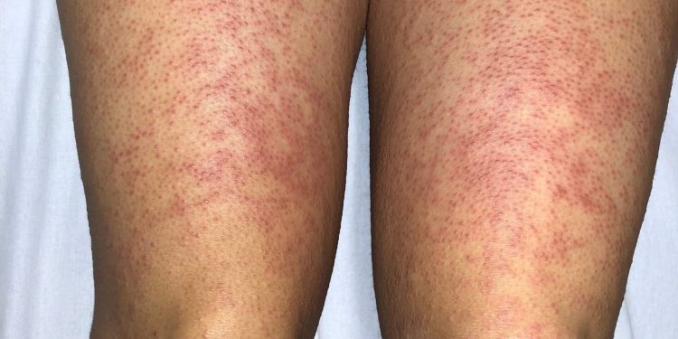 SAEM Clinical Images Series: Red Rash on My Legs