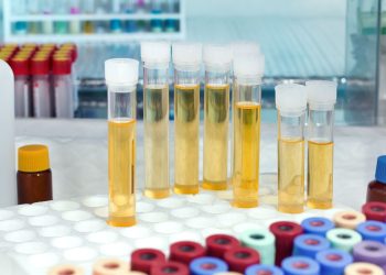 Un test de urină la domiciliu, dezvoltat pentru a descoperi cancerele din sfera ORL